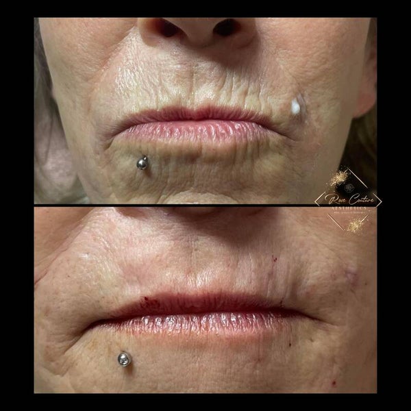 Dermal Filler for Youthful Radiance