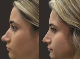Best Non surgical Rhinoplasty