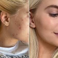 Best Acne Transformation