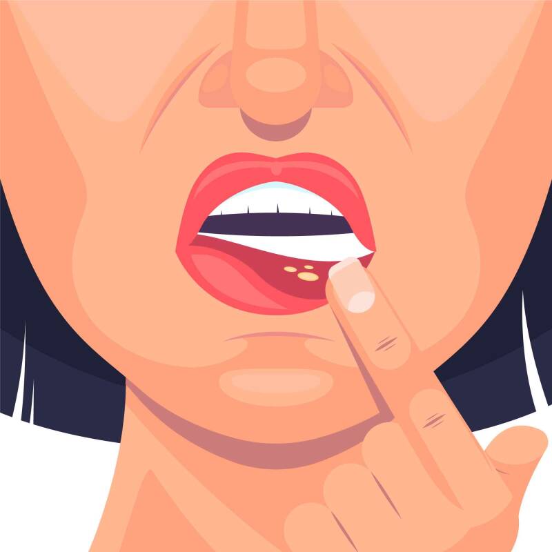 Vectorgrafik von einem Lippenherpes