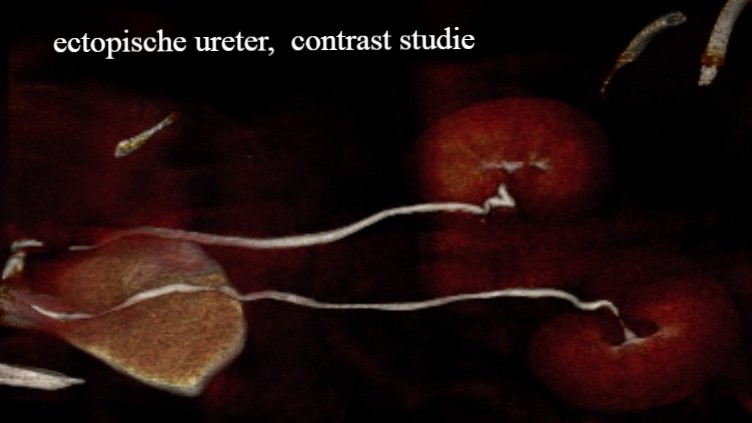 ectopische ureter