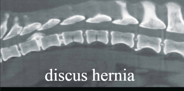 discus hernia