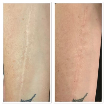 Scar Camouflage