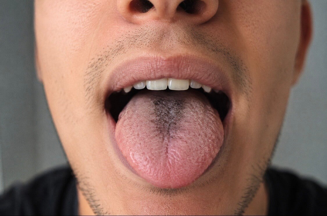Hombre Joven con pelos en la lengua