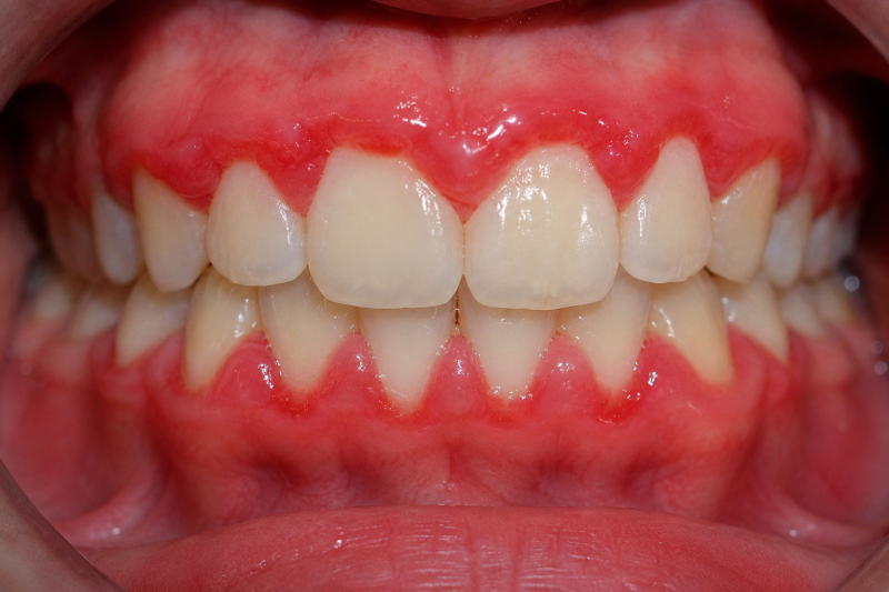 Boca con gingivitis 