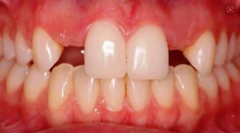 Agenesia dental