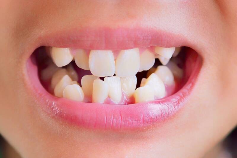 Malposición dental 