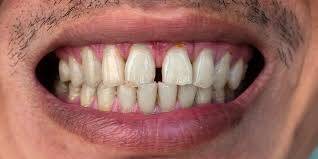 Diastema 