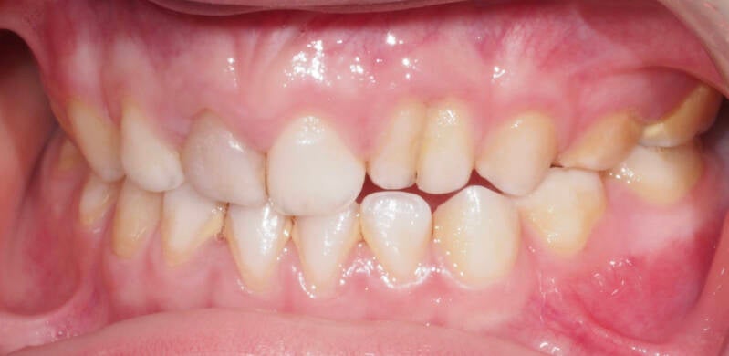 Fusión dental 