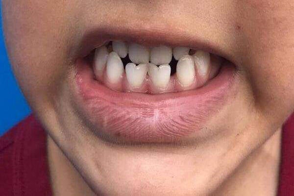 Geminación dental 