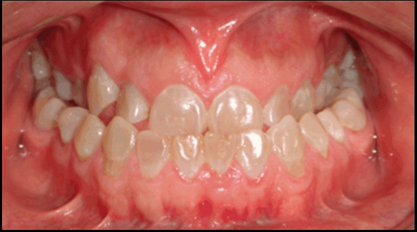 Dentinogénesis imperfecta