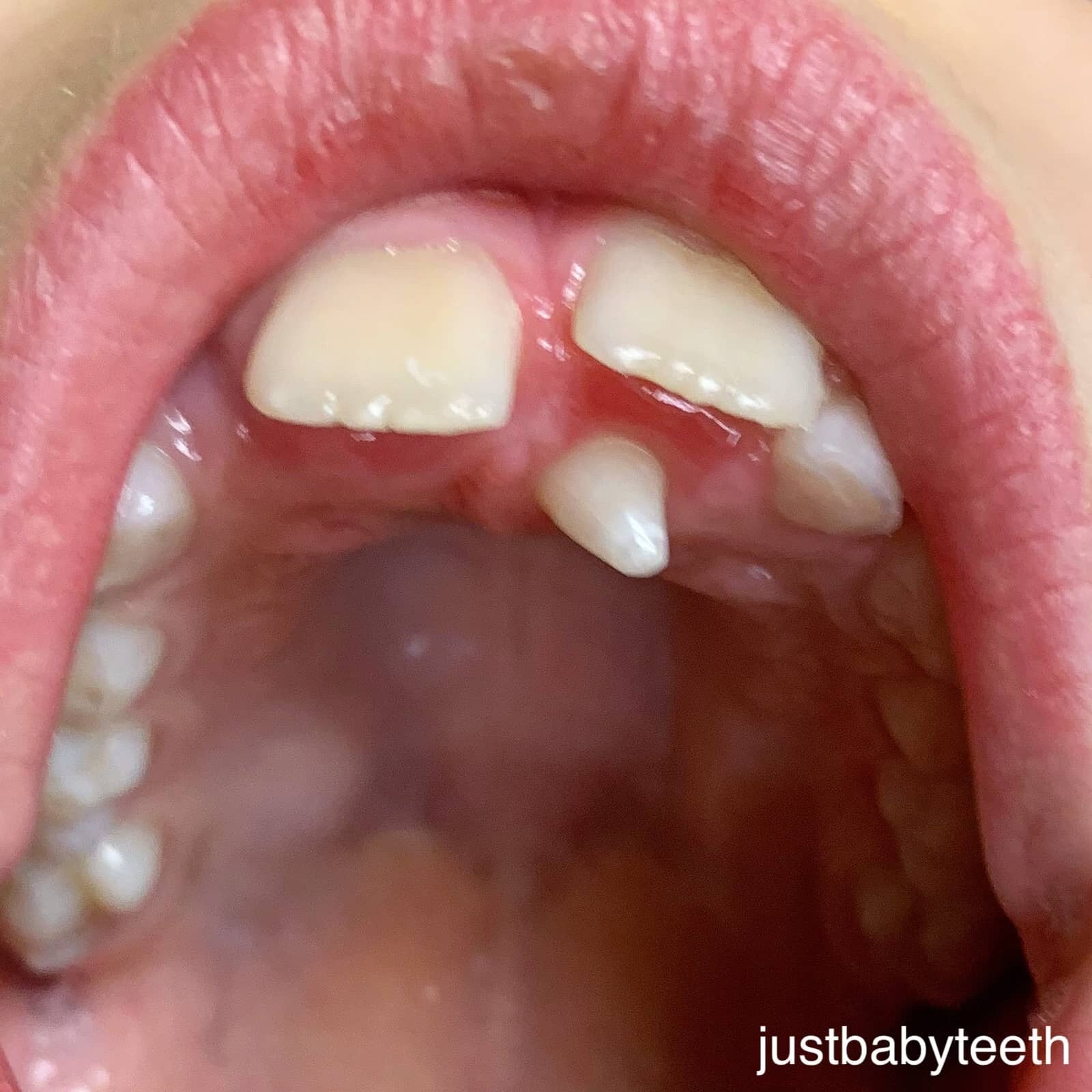 Dientes supernumerarios 