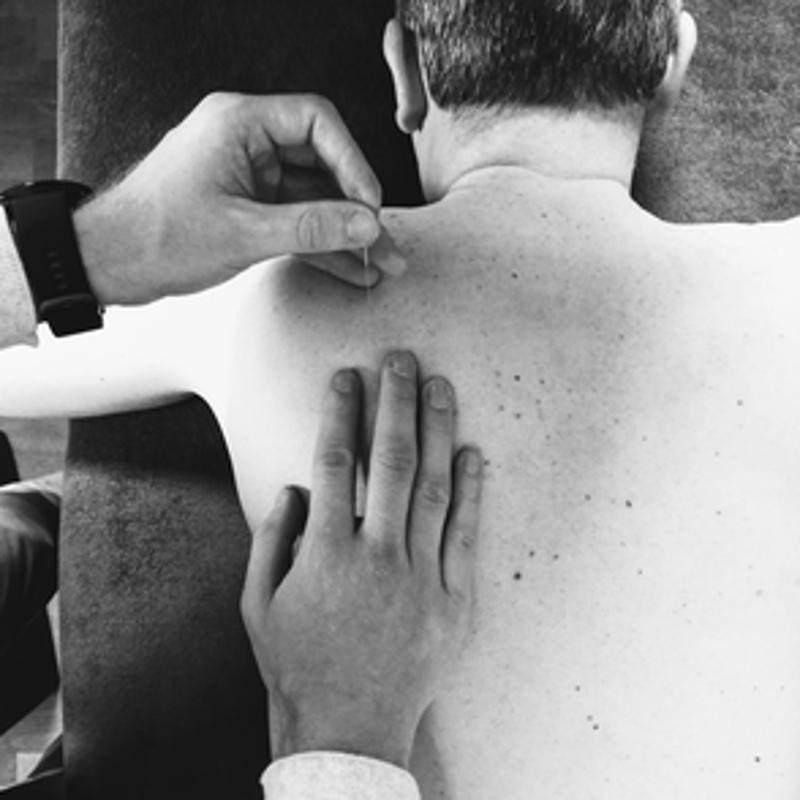 Dry needling