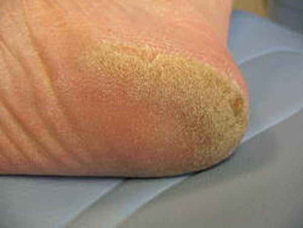 Gespecialiseerde Pedicure