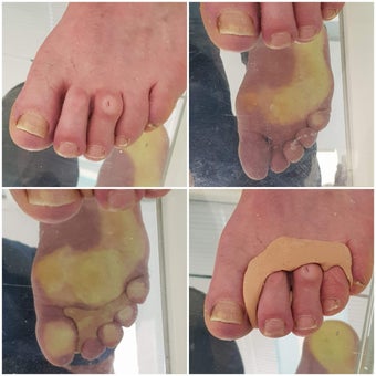 behandeling likdoorn ringorthese