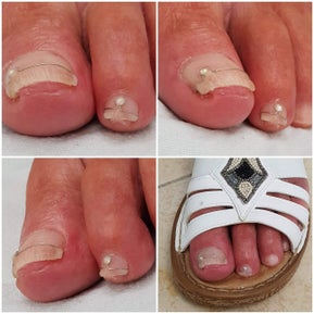 nagelregulatie draadbeugel