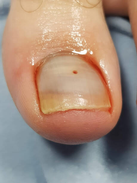 bloeding onder nagel behandelen