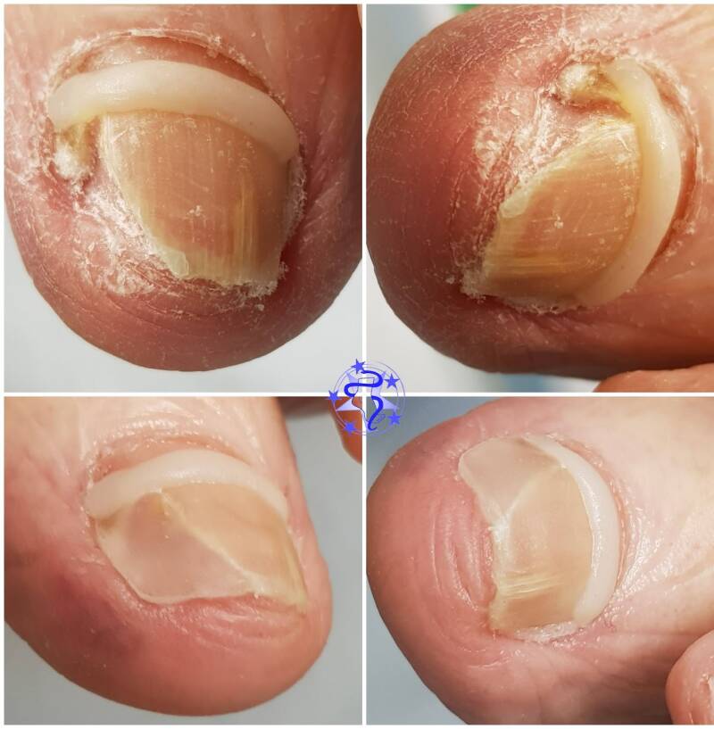 composiet beugel + reparatie