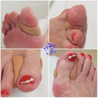 hallux valgus orthese