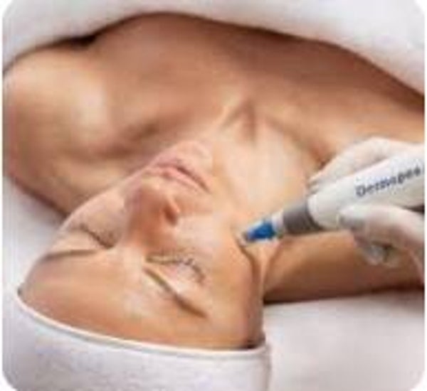 Microneedling