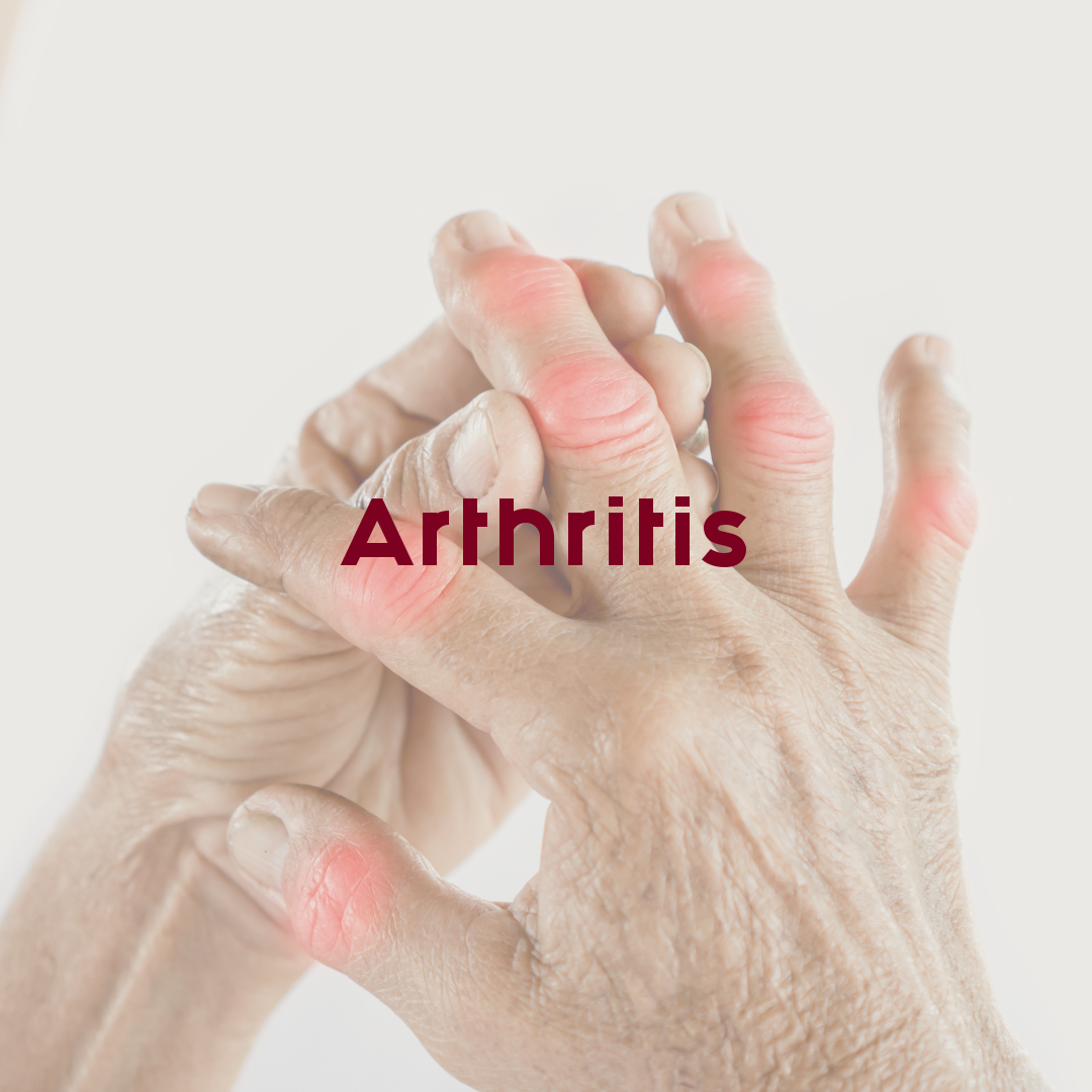 Arthritis