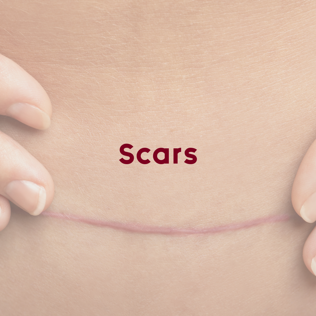 Scars