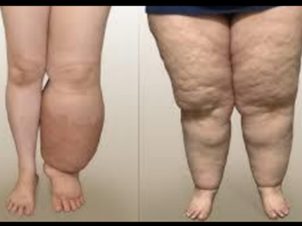 "What's lymph gotta do with it?" April 23rd, 2026 Thursday