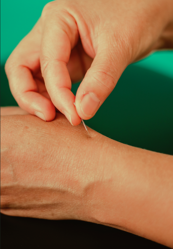 acupunctuurbehandeling Veldhoven