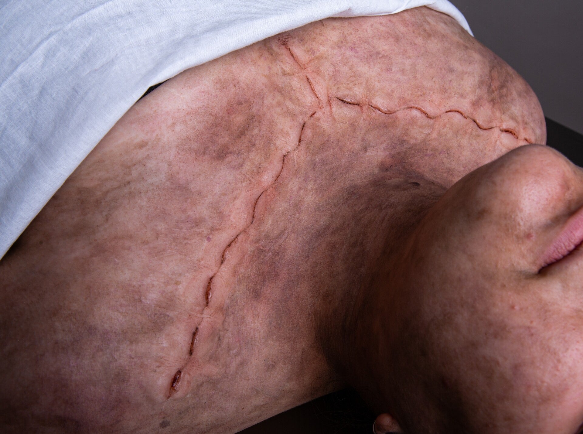 Prothèse suture d'autopsie