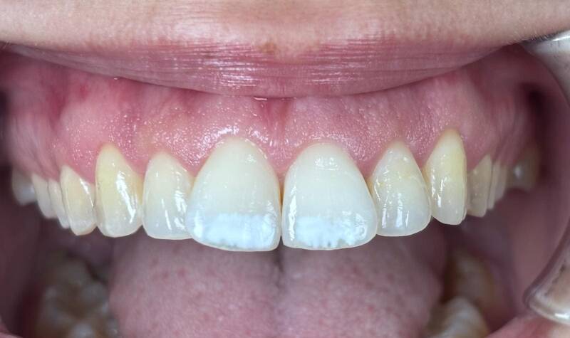 Gingivectomía una semana después.