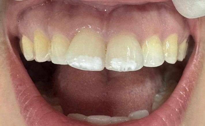 Sonrisa gingival de una paciente que acudió a clínica.