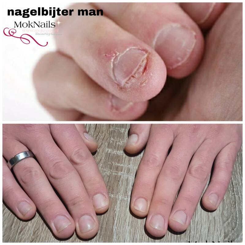 nagelbijten Deventer man