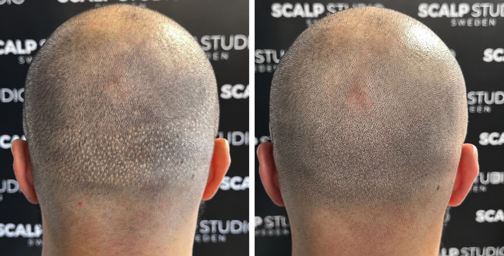 Scalppigmentatie bij Skintastic Brugge / harttransplantatie littekens verbergen