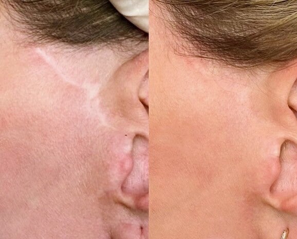 Waar kan ik mijn littekens laten verbeteren in Brugge? War kan ik mijn littekens , LITTEKENS CORRIGEREN - MEDISCHE TATOEAGE - CAMOUFLAGE LITTEKENS - HUIDVERKLEURINGEN - VITILIGO - HUIDSKLEUR AANPASSEN - MEDISCHE TATOEAGE - DERMATOPIGMENTATIE 