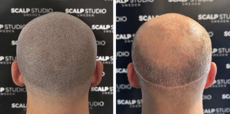 Scalppigmentatie bij Skintastic Brugge / harttransplantatie littekens verbergen.