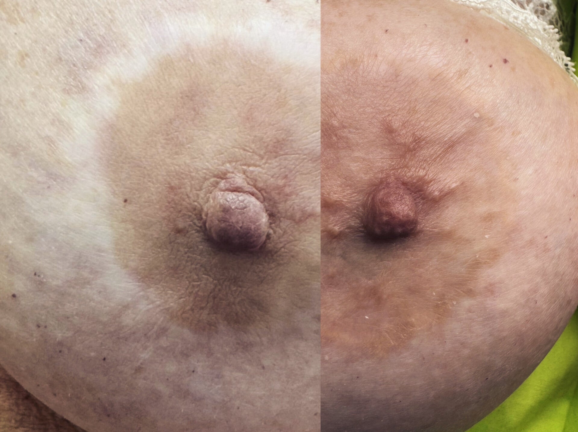 LITTEKENS CORRIGEREN - MEDISCHE TATOEAGE - CAMOUFLAGE LITTEKENS - HUIDVERKLEURINGEN - VITILIGO - HUIDSKLEUR AANPASSEN - MEDISCHE TATOEAGE - DERMATOPIGMENTATIE 
