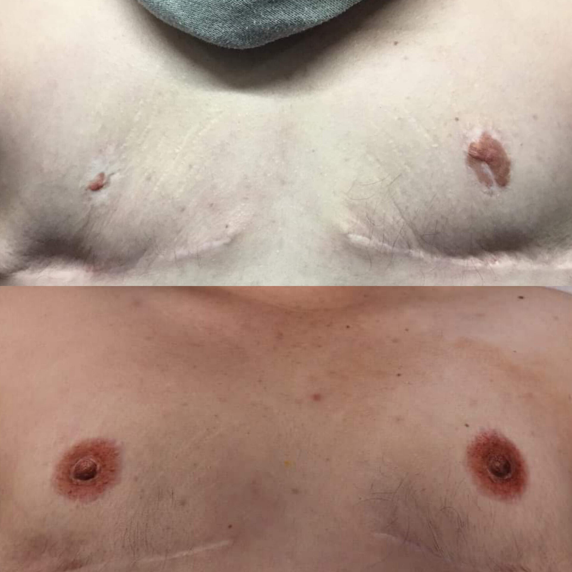 Waar kan ik mijn littekens laten verbeteren in Brugge? Transgender , LITTEKENS CORRIGEREN - MEDISCHE TATOEAGE - CAMOUFLAGE LITTEKENS - HUIDVERKLEURINGEN - VITILIGO - HUIDSKLEUR AANPASSEN - MEDISCHE TATOEAGE - DERMATOPIGMENTATIE 