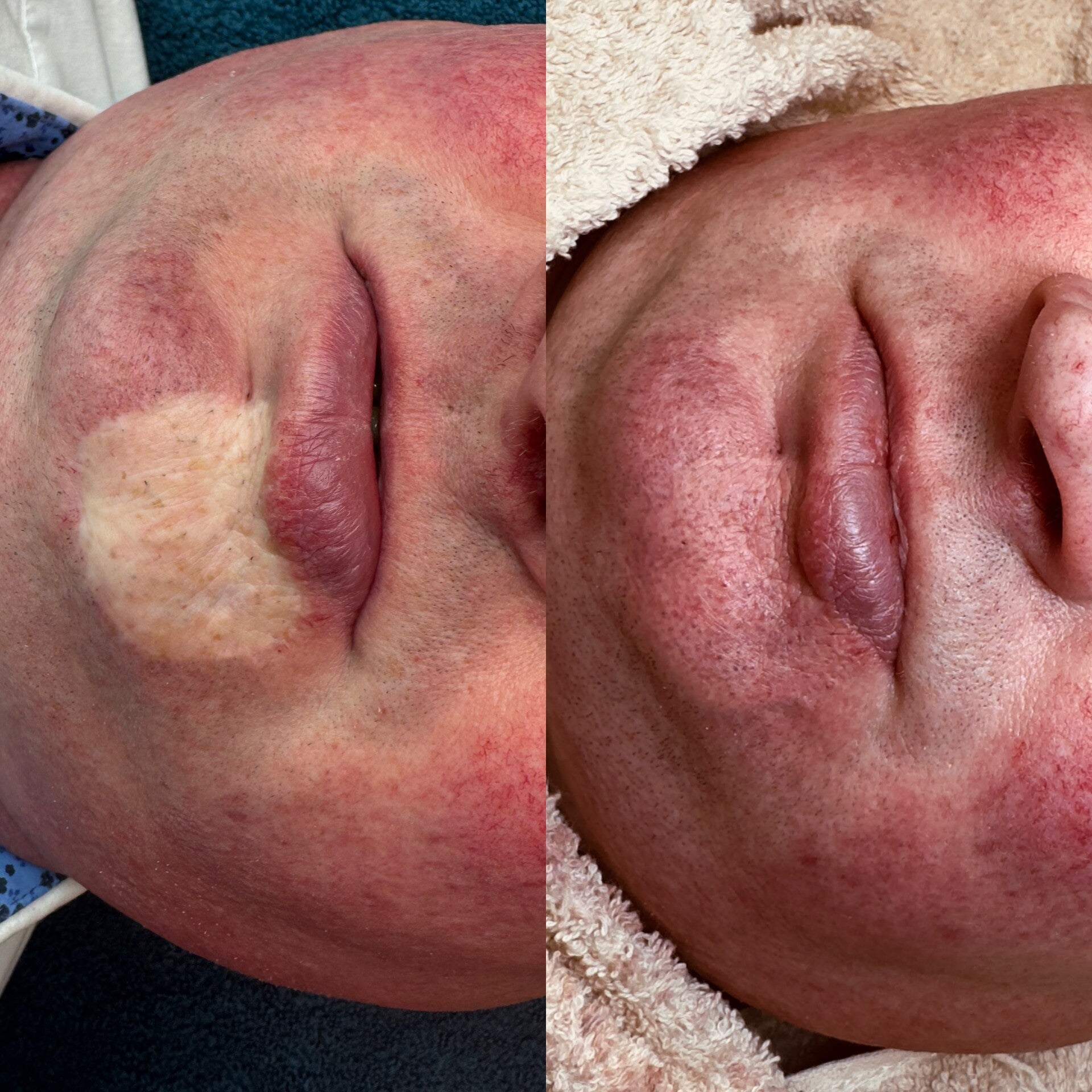 LITTEKENS CORRIGEREN - MEDISCHE TATOEAGE - CAMOUFLAGE LITTEKENS - HUIDVERKLEURINGEN - VITILIGO - HUIDSKLEUR AANPASSEN - MEDISCHE TATOEAGE - DERMATOPIGMENTATIE  - CORRECTIE NA ABDOMINOPLASTIE - NA BORSTVERKLEINING - NA BORSTVERGROTING - OPERATIE LITTEKENS