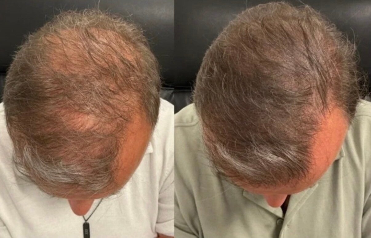 Voorschot scalppigmentatie gedeeltelijke scalp