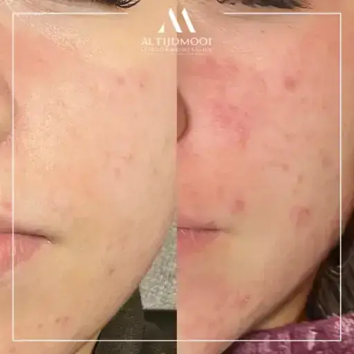 acne-behandeling-schoonheidssalon-altijdmooi-in-maarssen-standard-eptruc.webp