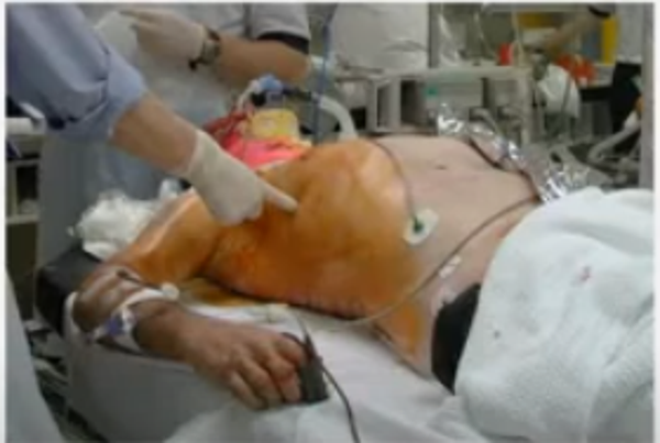 Management of Chest Trauma