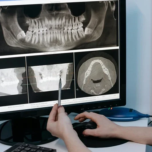 Circular photo of hands pointing to CBCT dental scan on screen showing full jaw X-rays