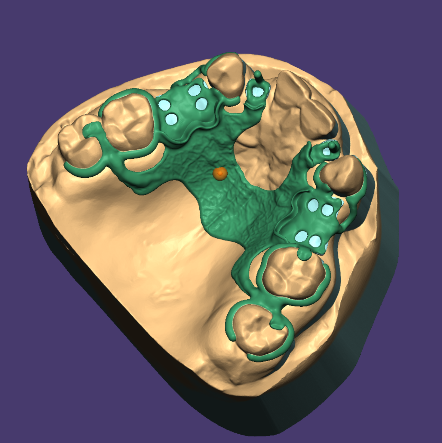 3D model of partial removable denture rpd, example of CAD/CAM dental restoration design for labs