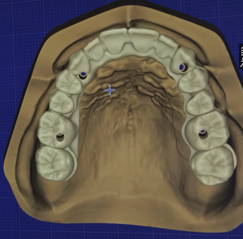 3D visual full arch cad cam design