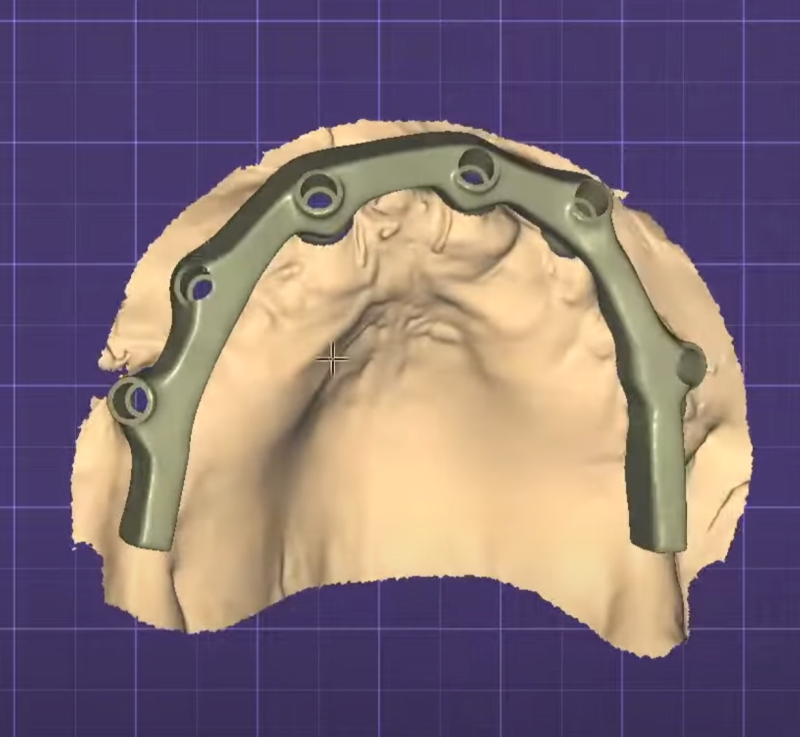 3d dental bar cad cam design
