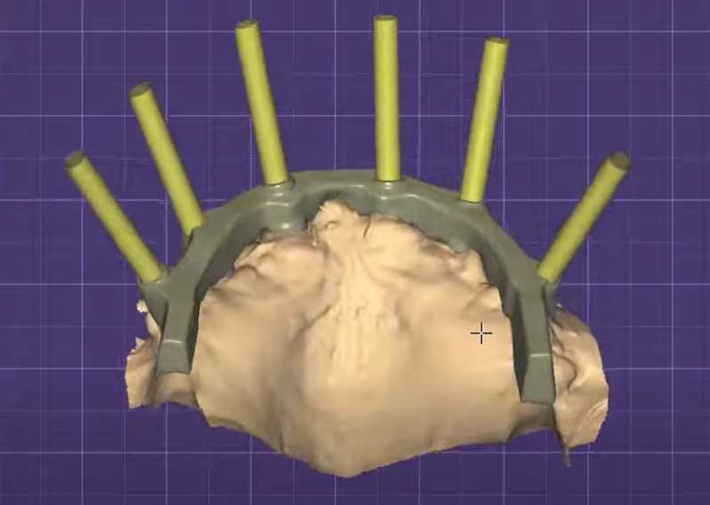 3d dental bar cad cam design