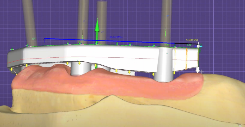 3d dental bar cad cam design