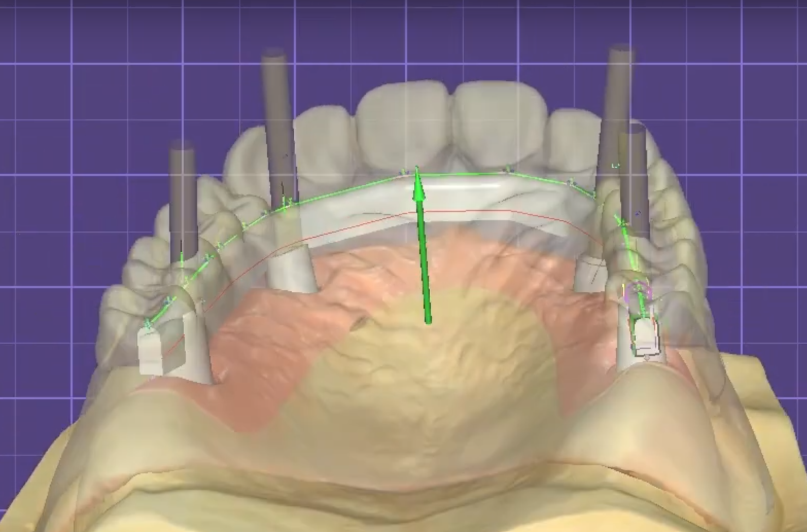 3D dental BAR on upper arch model, fast CAD design services for US labs