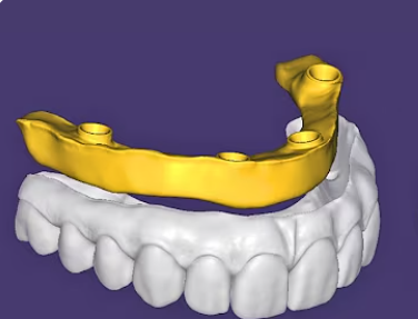 3D visual full arch cad cam design