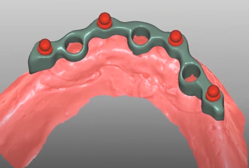 3d dental bar cad cam design